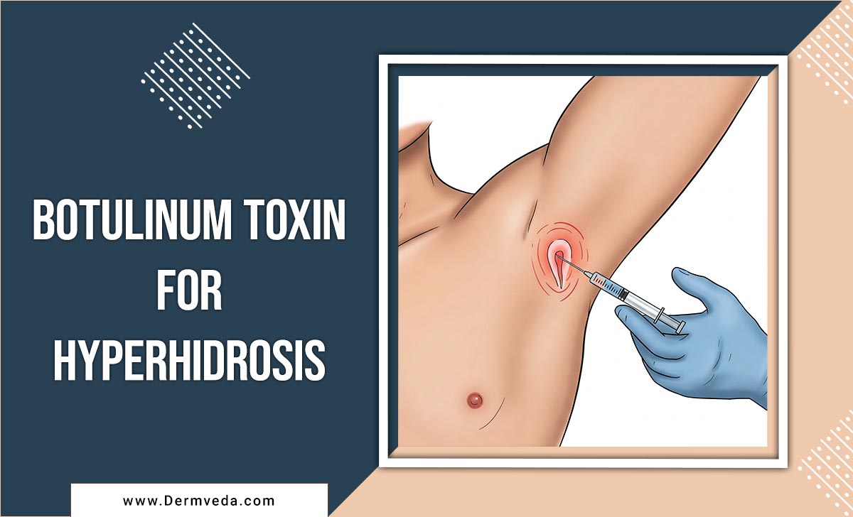 Botulinum Toxin For Hyperhidrosis
