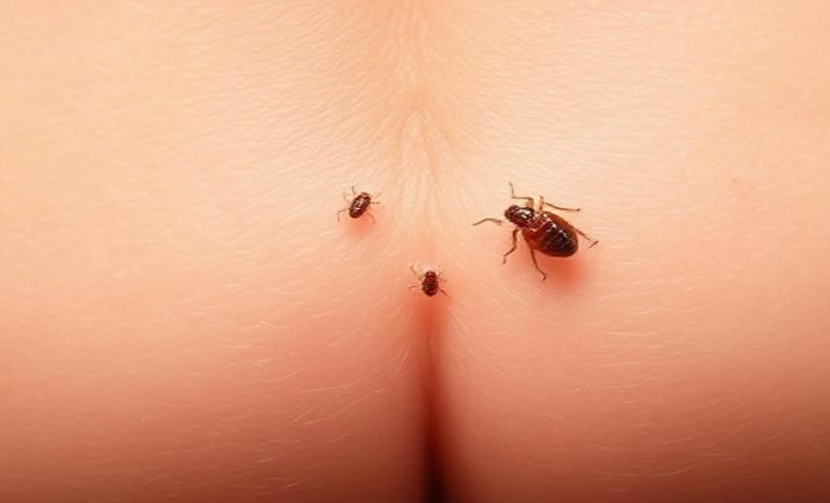 Preventive Measures To Avoid Pubic Lice