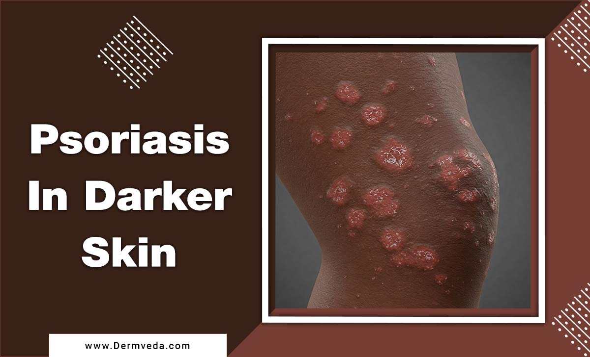 Psoriasis In Darker Skin