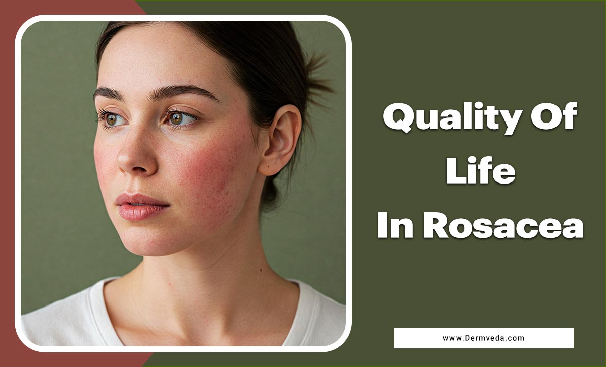 Quality Of Life In Rosacea
