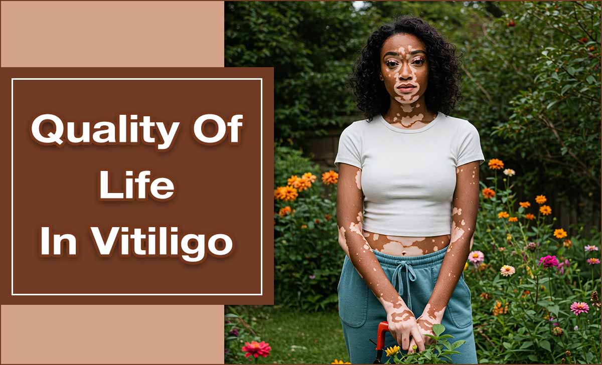 Quality Of Life In Vitiligo