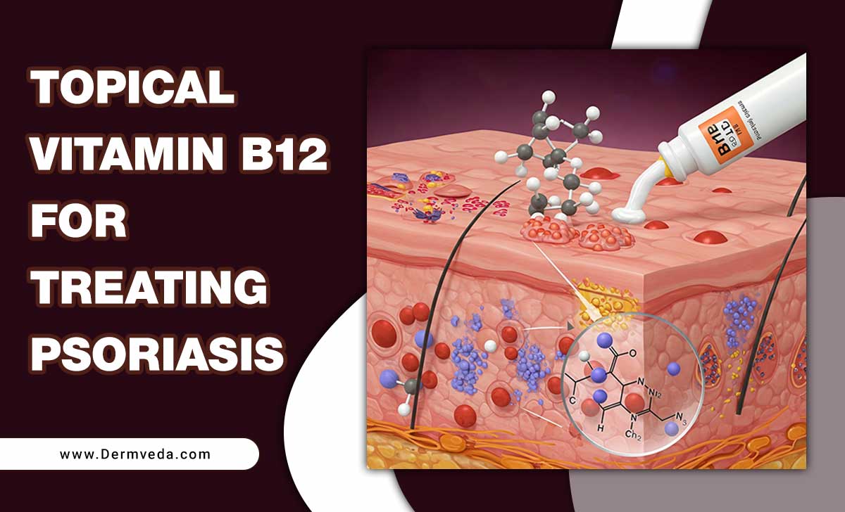 Topical Vitamin B12 For Treating Psoriasis