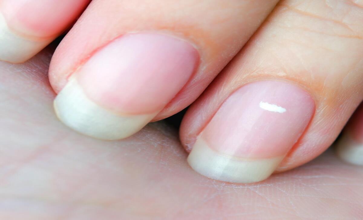 Understanding The Causes Of White Spots On Fingernails