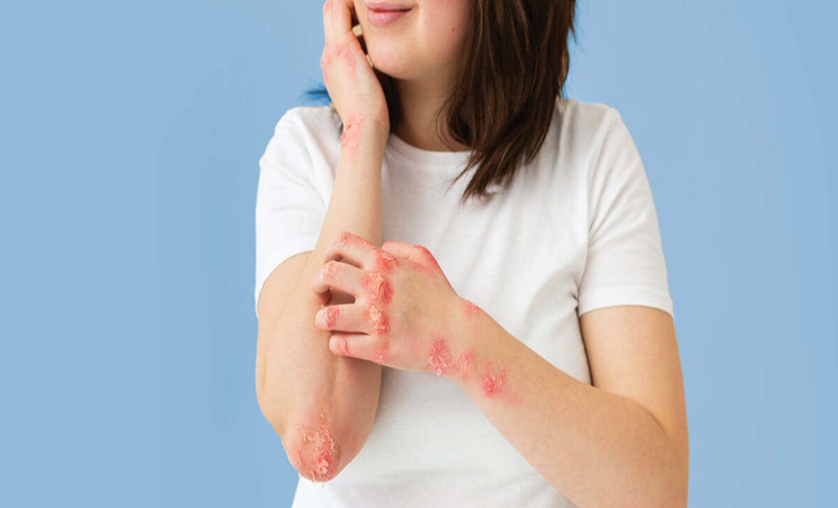What People Say About Psoriasis?
