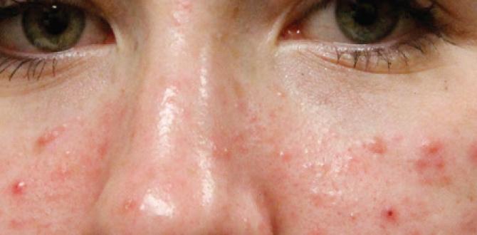 how to acne remedies how to acne remedies