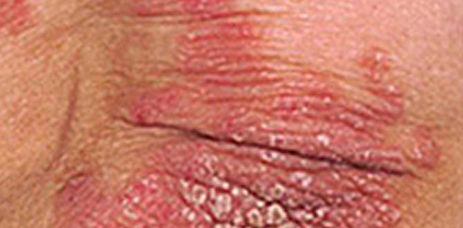 how to psoriasis tips how to psoriasis tips