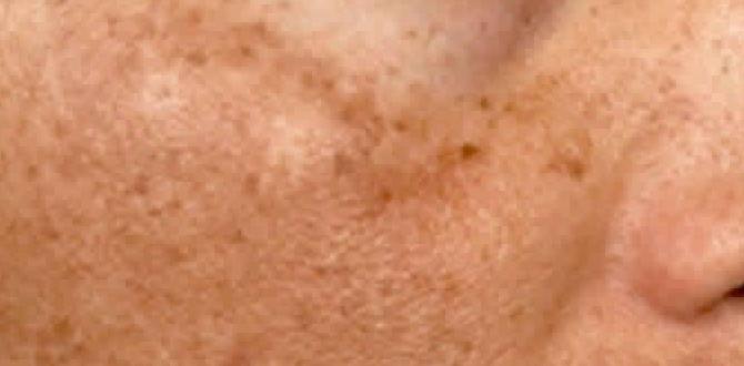 melasma on upper lip melasma on upper lip