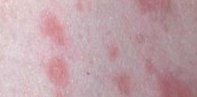 pityriasis rosea cure