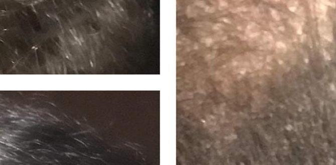 scalp psoriasis flakes scalp psoriasis flakes